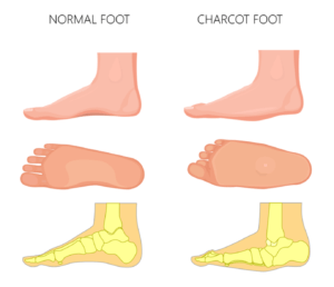 charcot-foot
