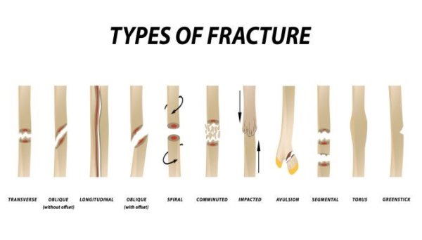 types of bone fracture