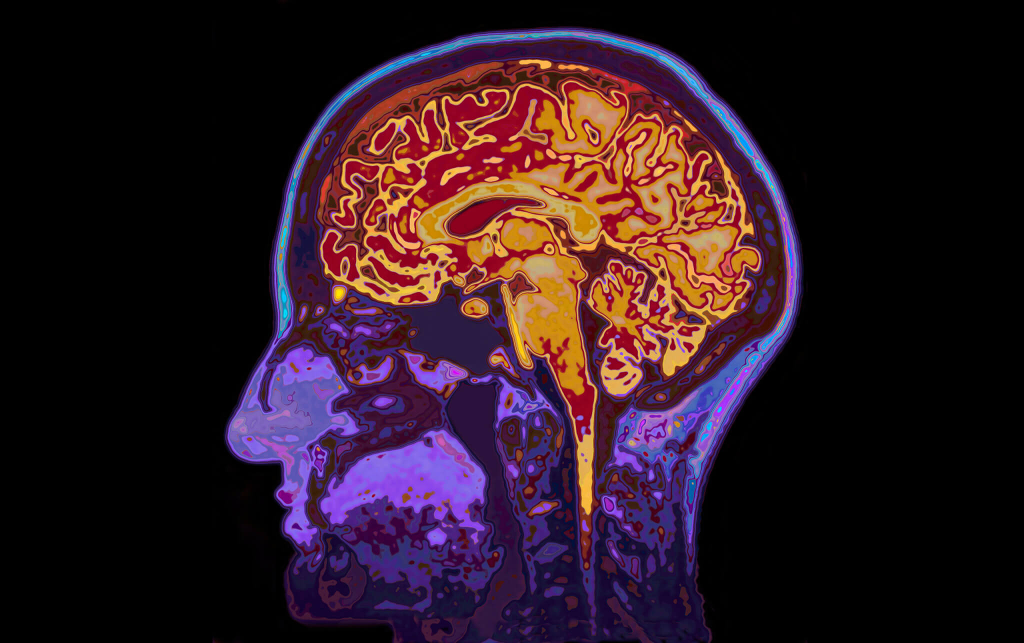 Delayed or misdiagnosis of a brain tumour